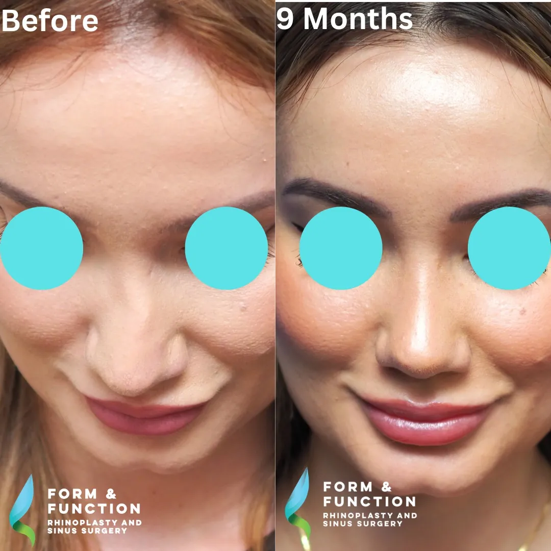 Before and after, right profile, 9 months after rhinoplasty and septoplasty