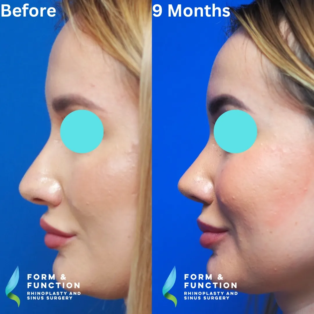 Before and after, 9 months after rhinoplasty and septoplasty (photograph 6 of 7)