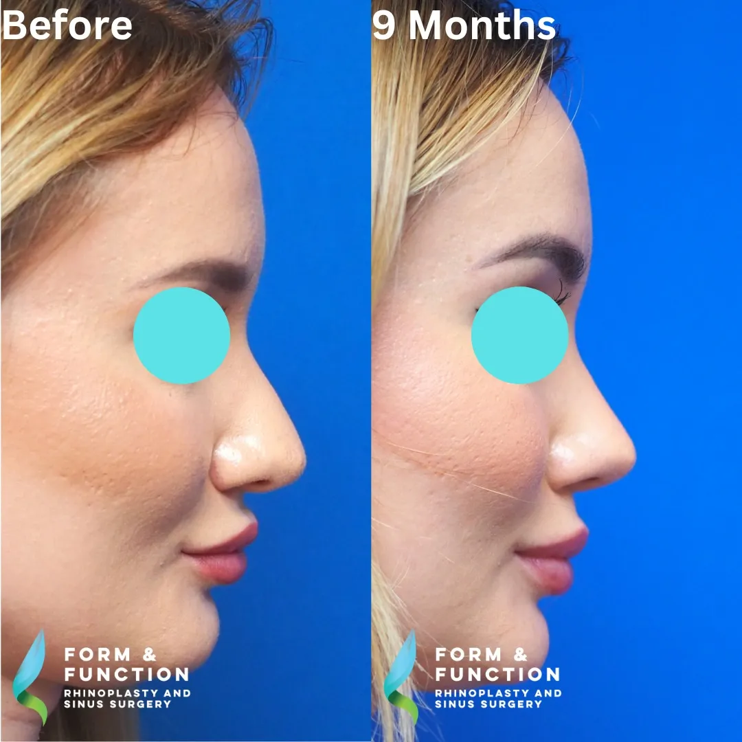 Before and after, 9 months after rhinoplasty and septoplasty (photograph 7 of 7)