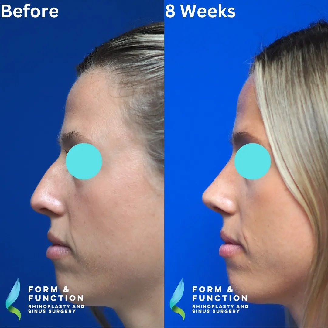 Before and after, right profile, 8 weeks after rhinoplasty and septoplasty