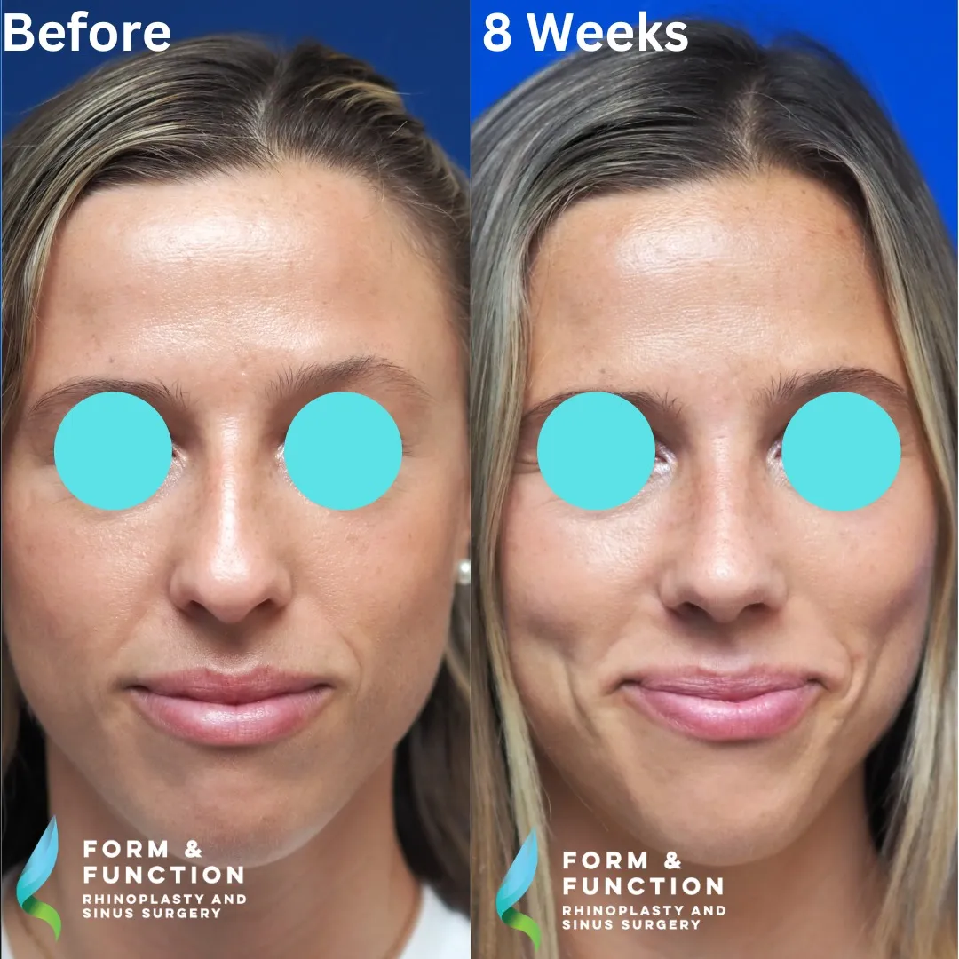 Before and after, frontal view, 8 weeks after rhinoplasty and septoplasty