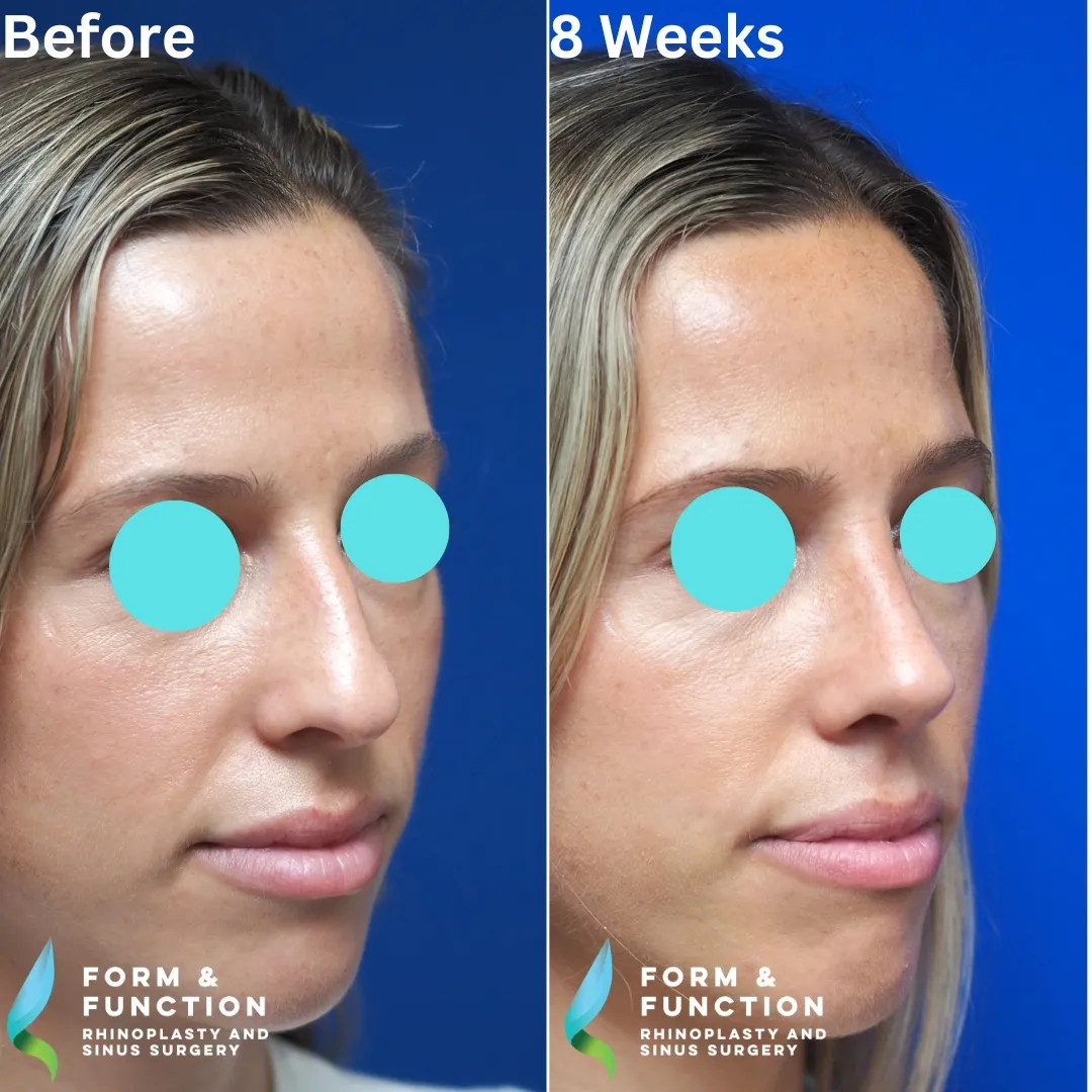 Before and after, left three-quarter view, 8 weeks after rhinoplasty and septoplasty