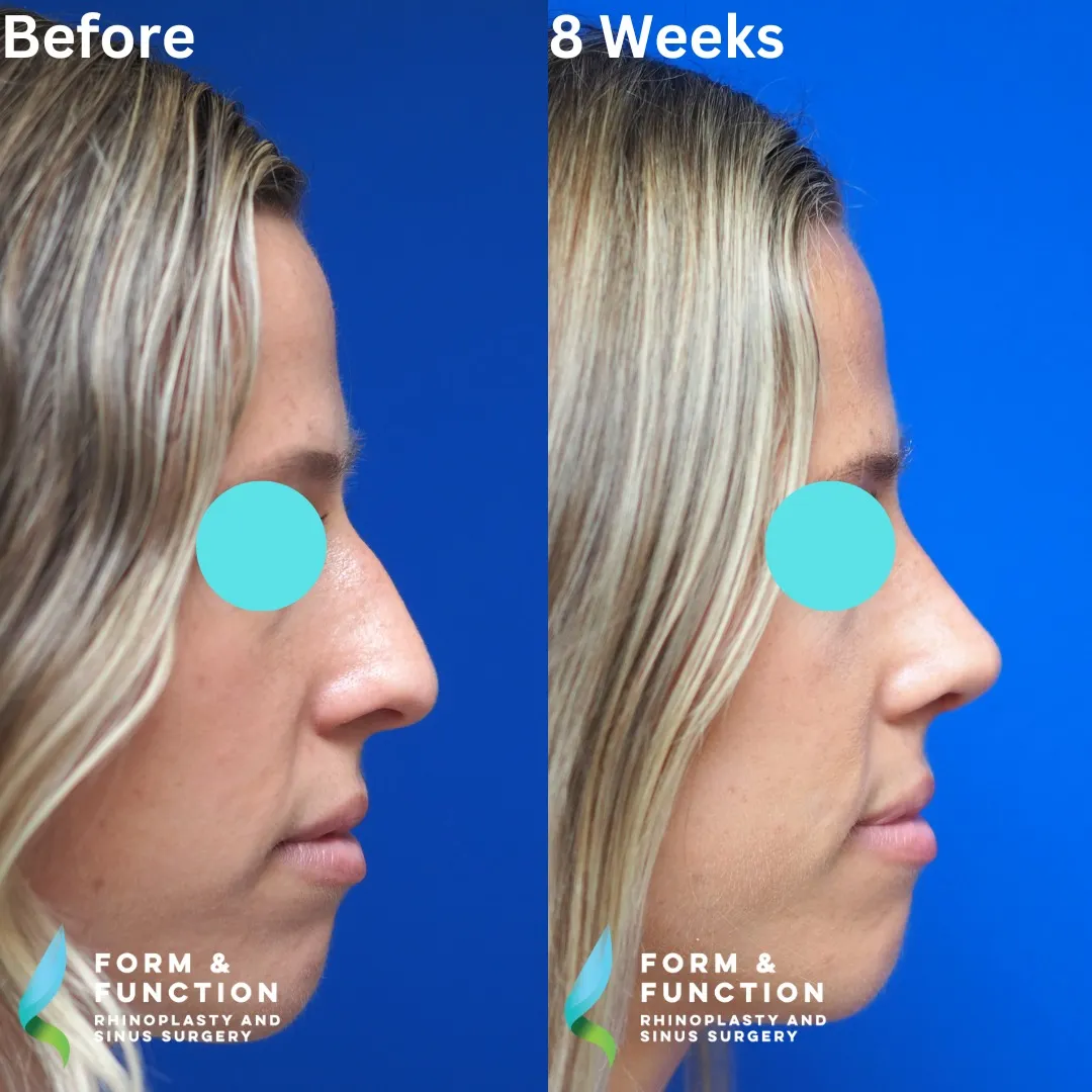 Before and after, 8 weeks after rhinoplasty and septoplasty (photograph 4 of 5)