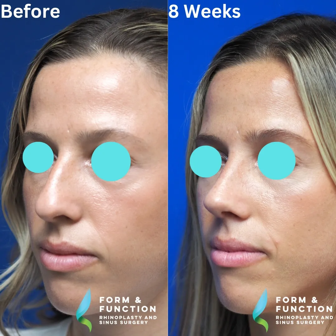 Before and after, 8 weeks after rhinoplasty and septoplasty (photograph 5 of 5)