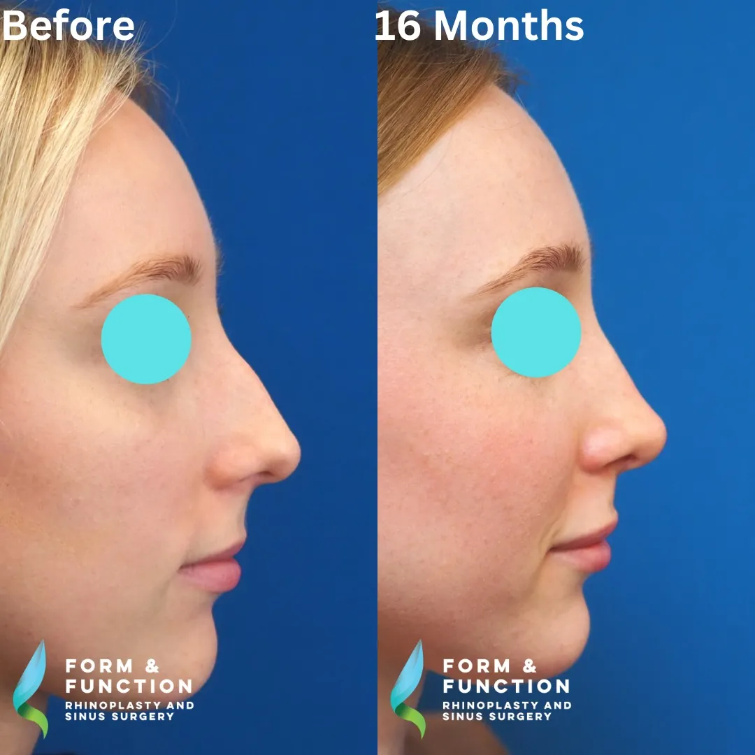 Before and after, 16 months after septorhinoplasty (photograph 1 of 3)