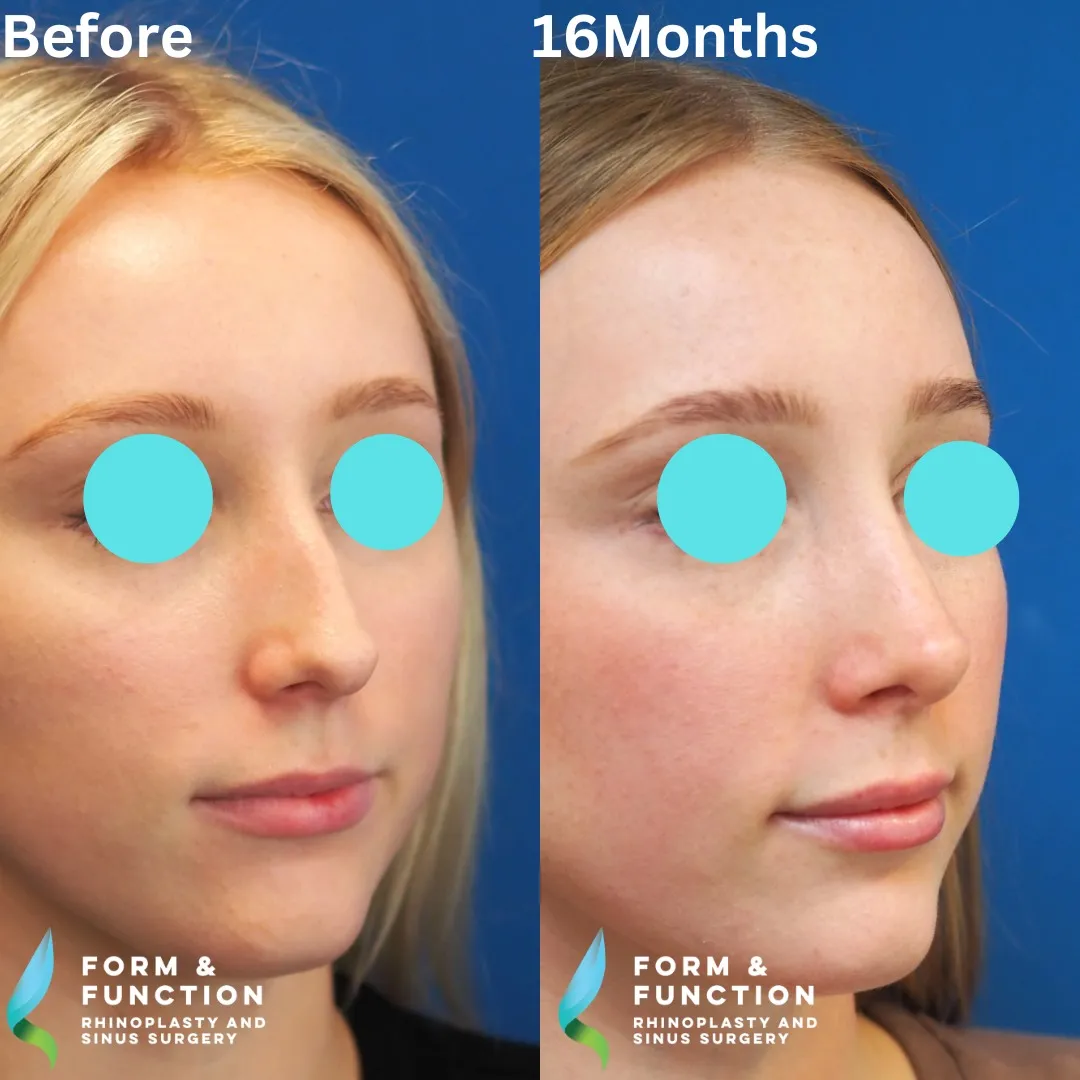 Before and after, 16 months after septorhinoplasty (photograph 2 of 3)