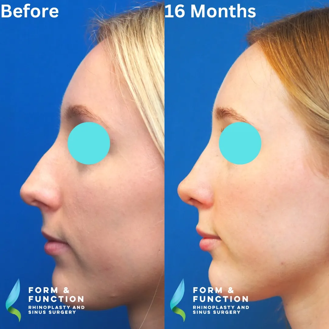 Before and after, 16 months after septorhinoplasty (photograph 3 of 3)