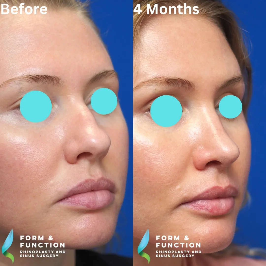 Before and after, 4 months after septorhinoplasty (photograph 1 of 8)