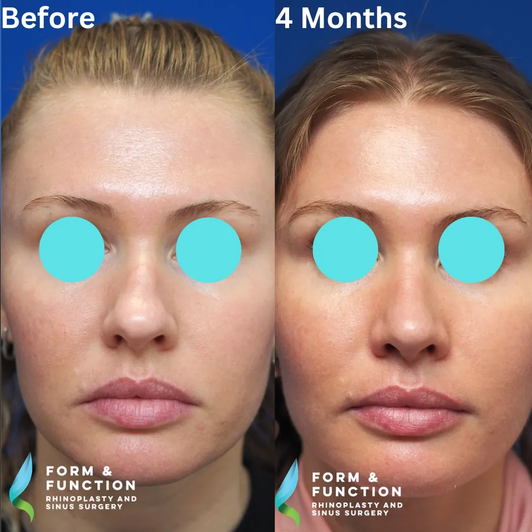 Before and after, 4 months after septorhinoplasty (photograph 2 of 8)