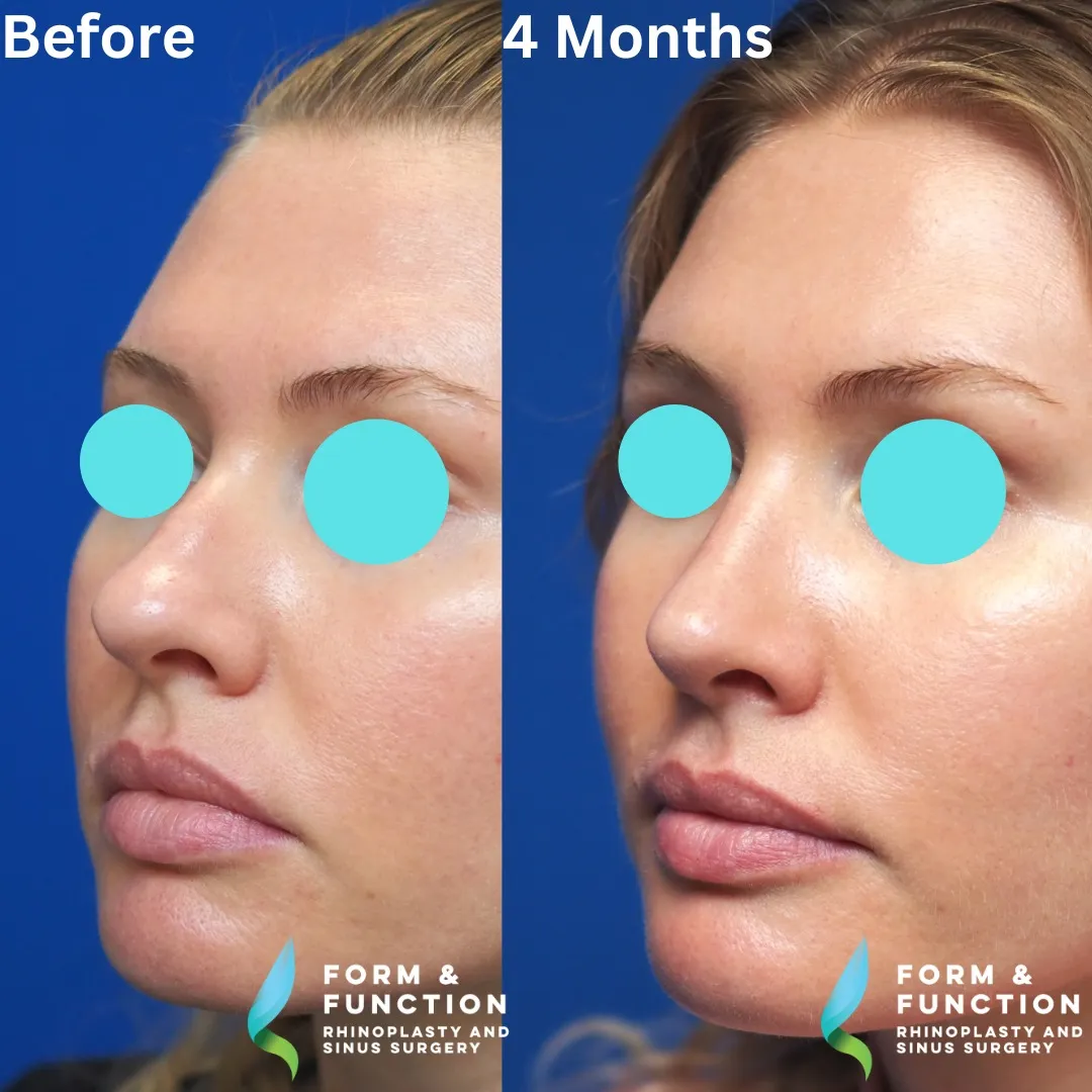 Before and after, 4 months after septorhinoplasty (photograph 3 of 8)