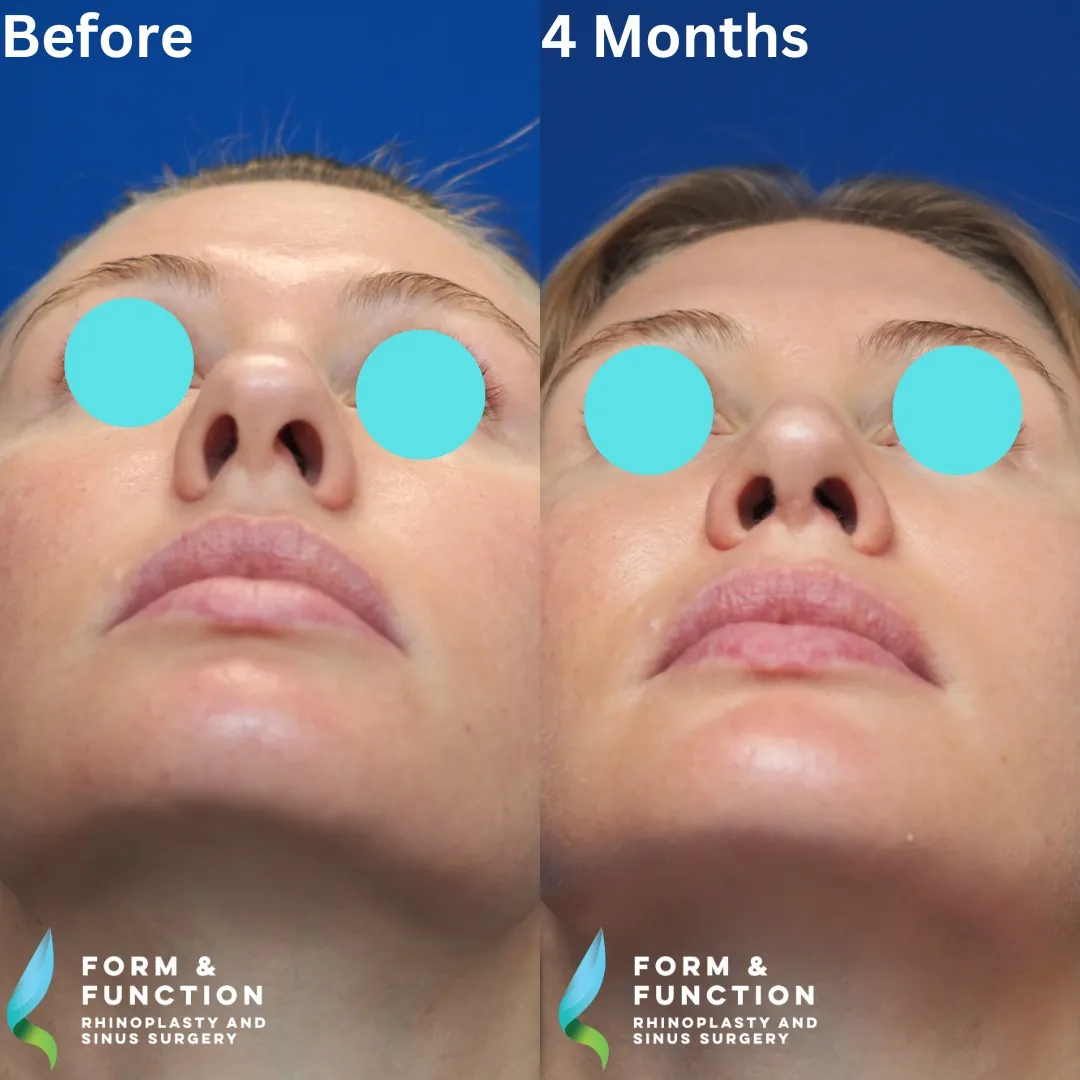 Before and after, 4 months after septorhinoplasty (photograph 4 of 8)