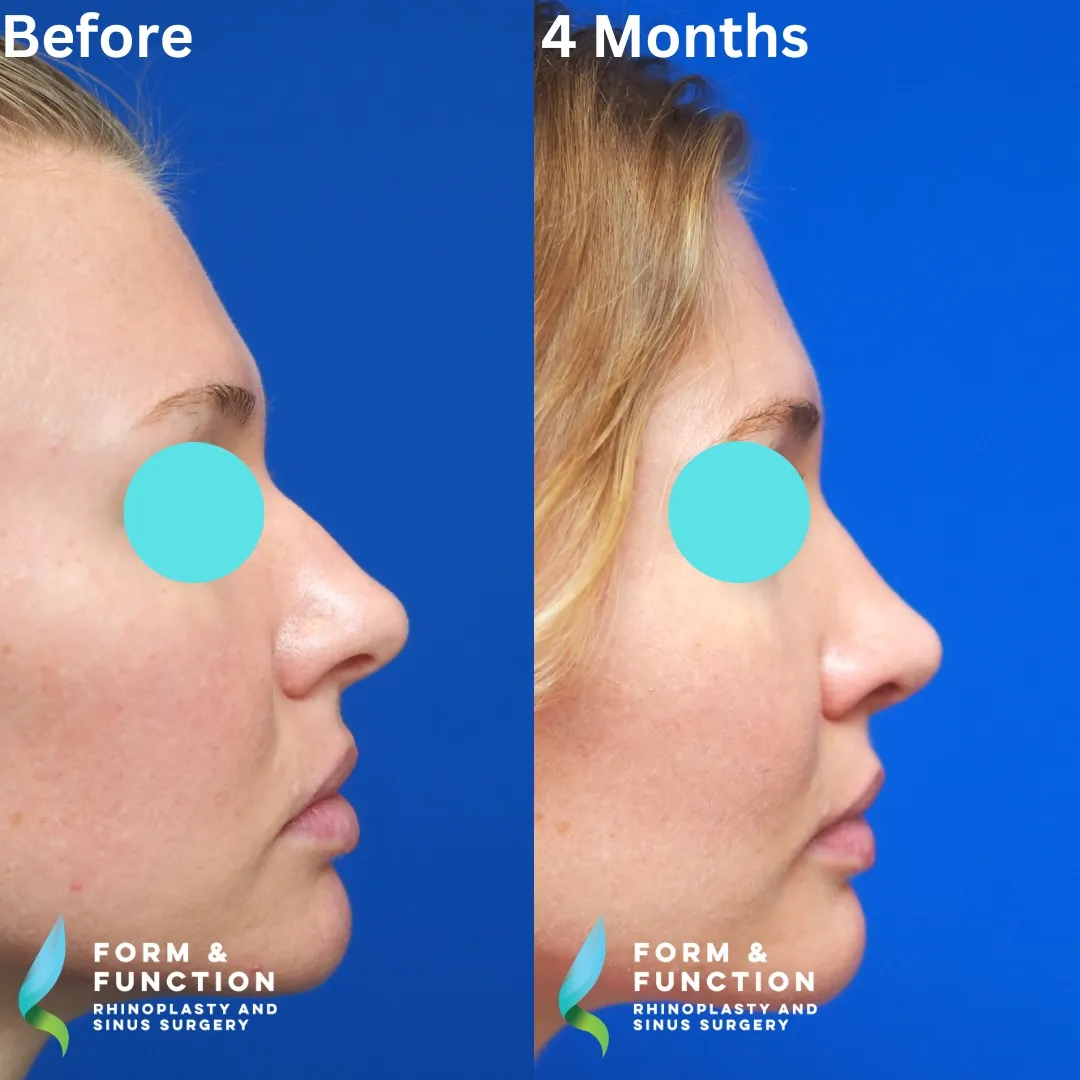Before and after, 4 months after septorhinoplasty (photograph 5 of 8)