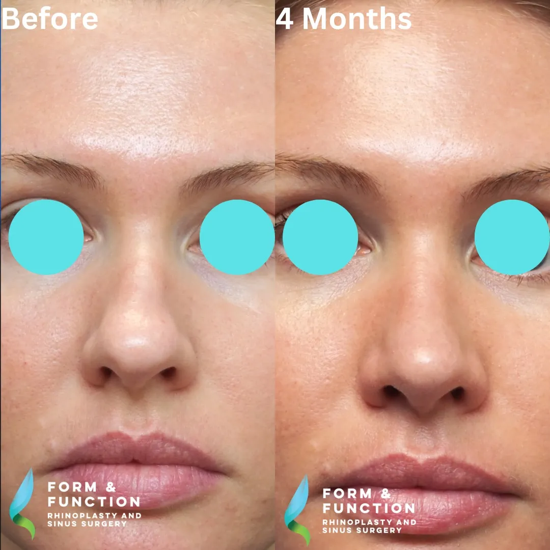 Before and after, 4 months after septorhinoplasty (photograph 6 of 8)