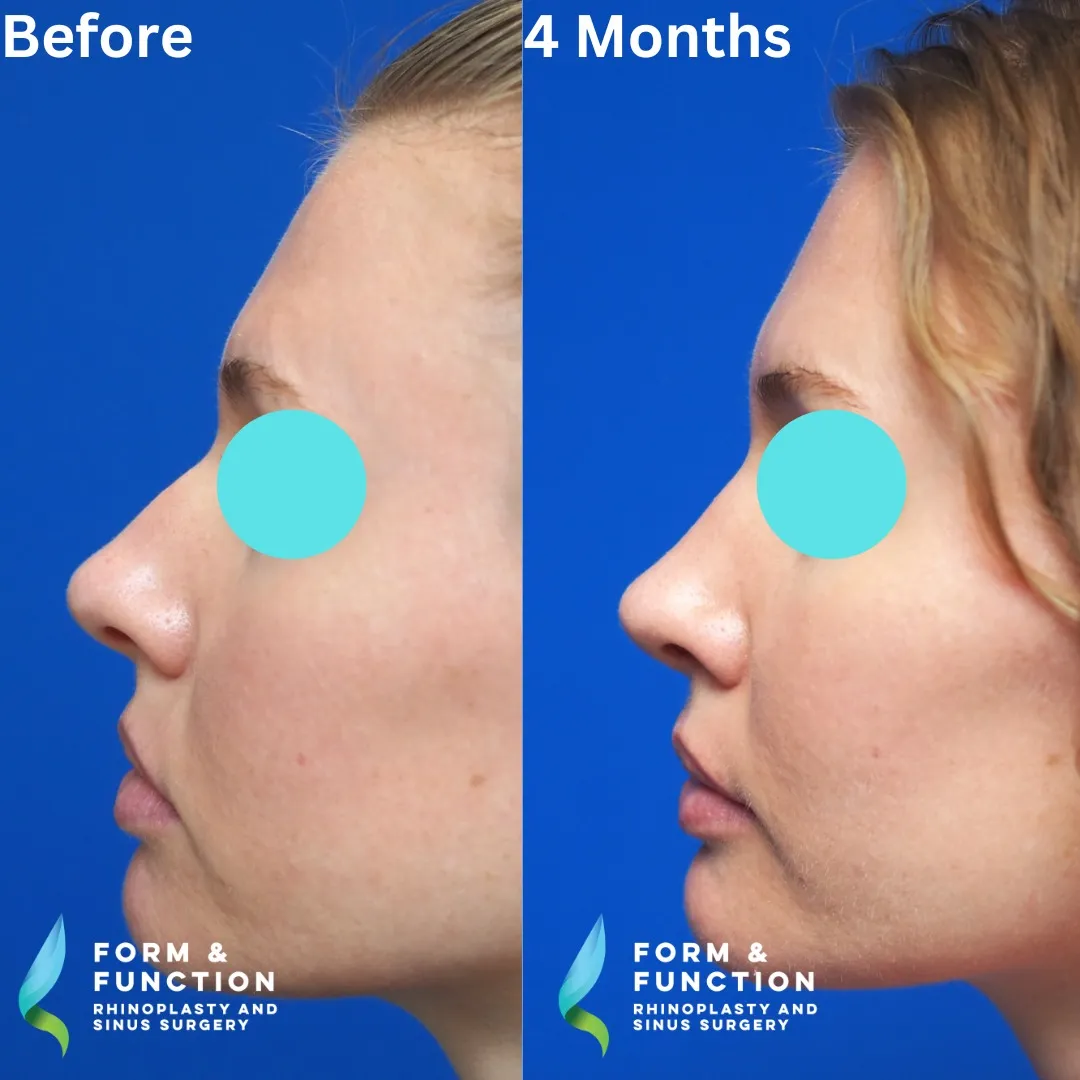 Before and after, 4 months after septorhinoplasty (photograph 7 of 8)