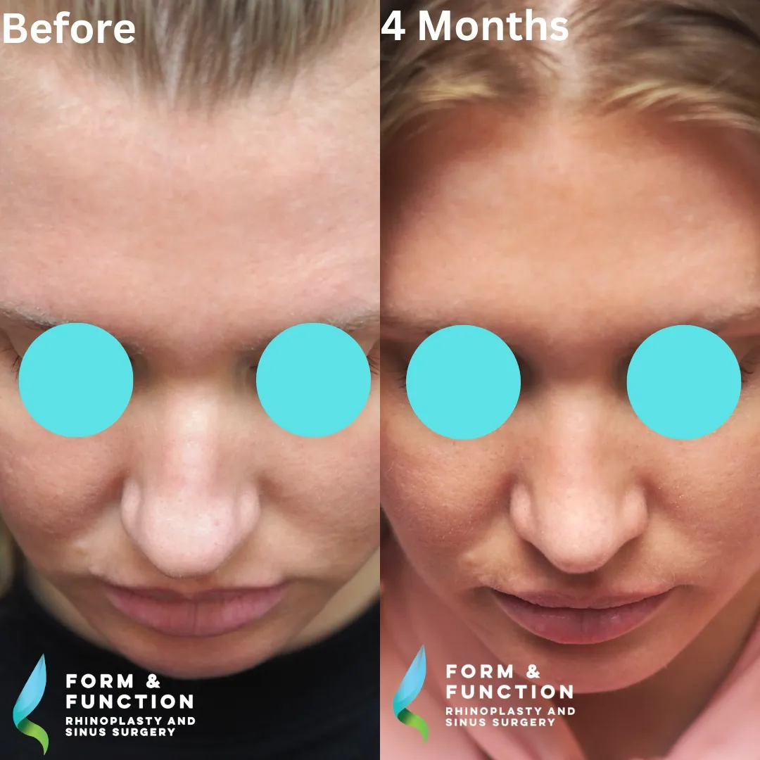 Before and after, 4 months after septorhinoplasty (photograph 8 of 8)