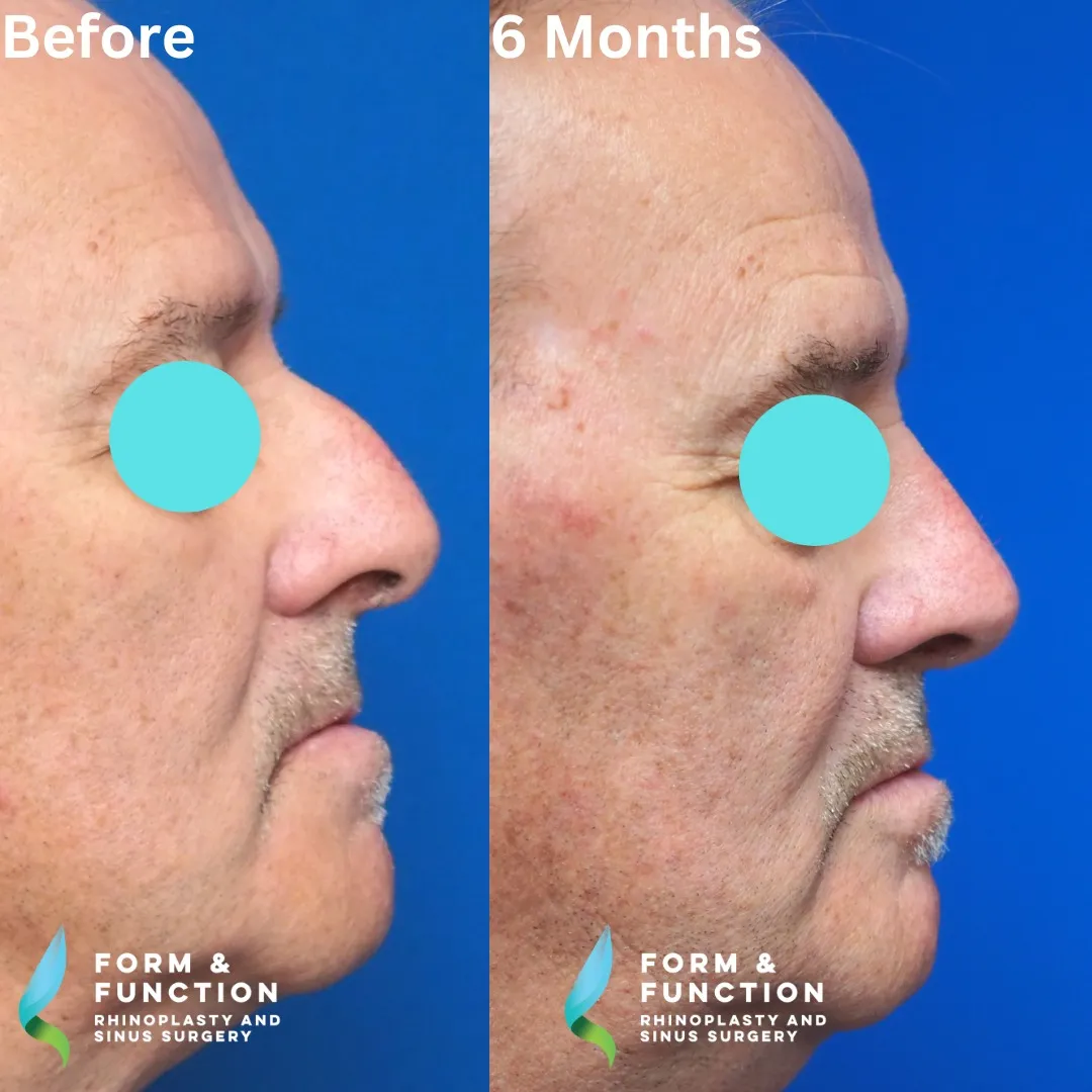 Before and after, 6 months after septorhinoplasty (photograph 1 of 5)