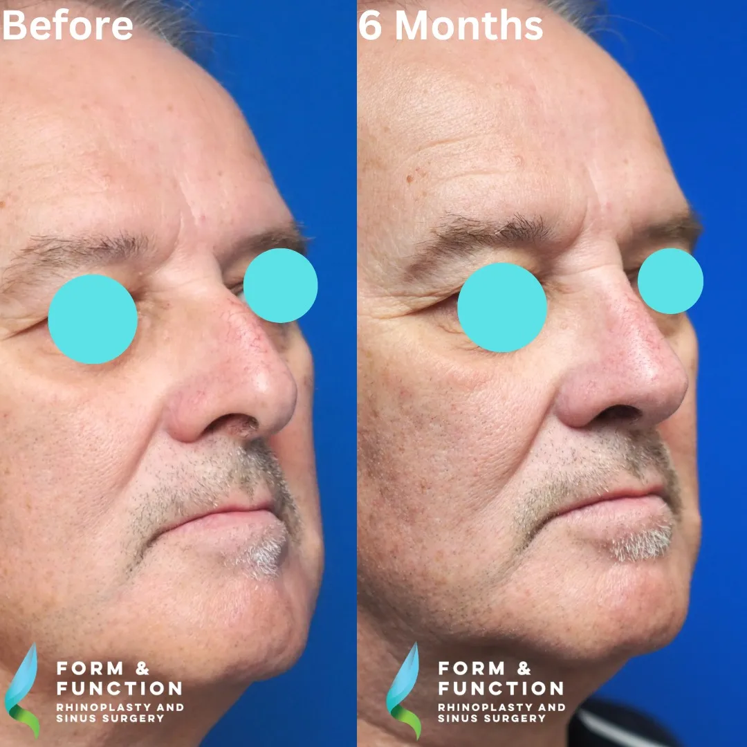 Before and after, 6 months after septorhinoplasty (photograph 2 of 5)