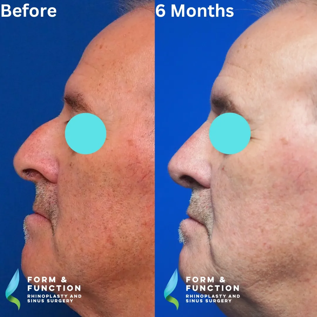 Before and after, 6 months after septorhinoplasty (photograph 3 of 5)
