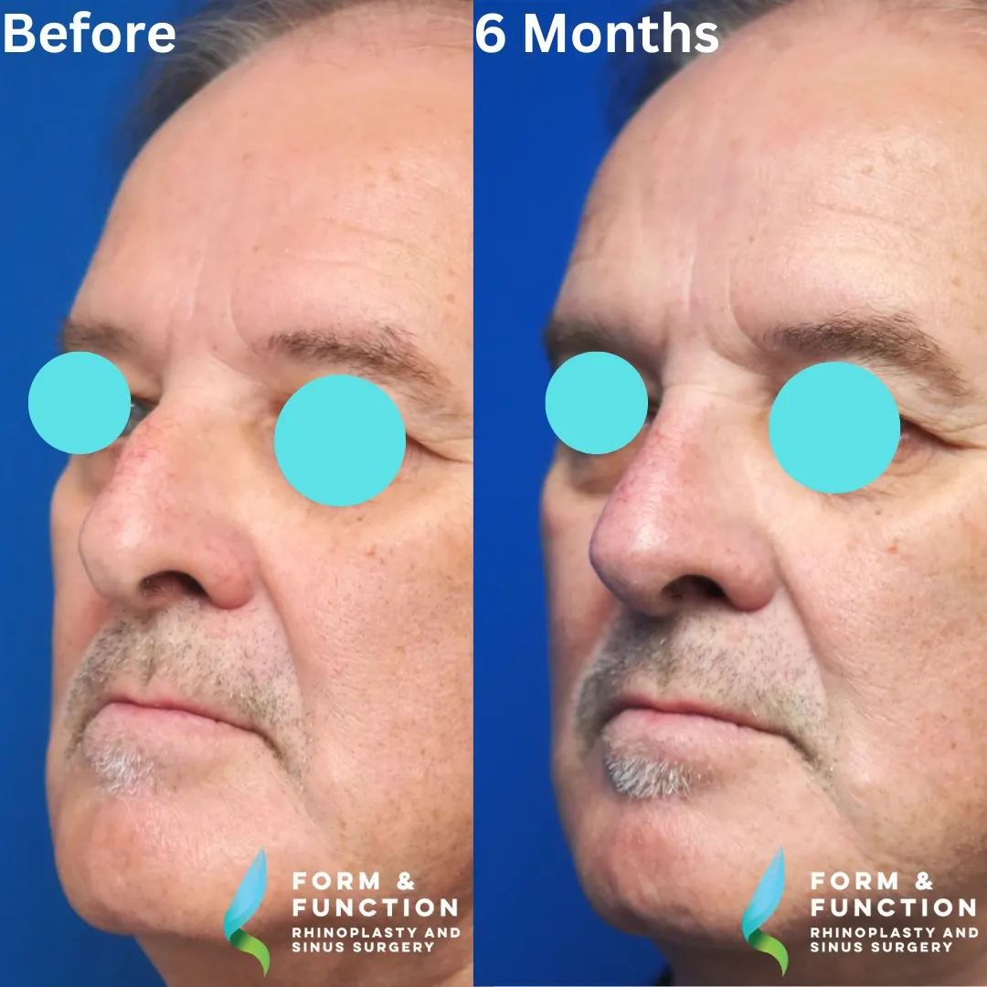 Before and after, 6 months after septorhinoplasty (photograph 4 of 5)