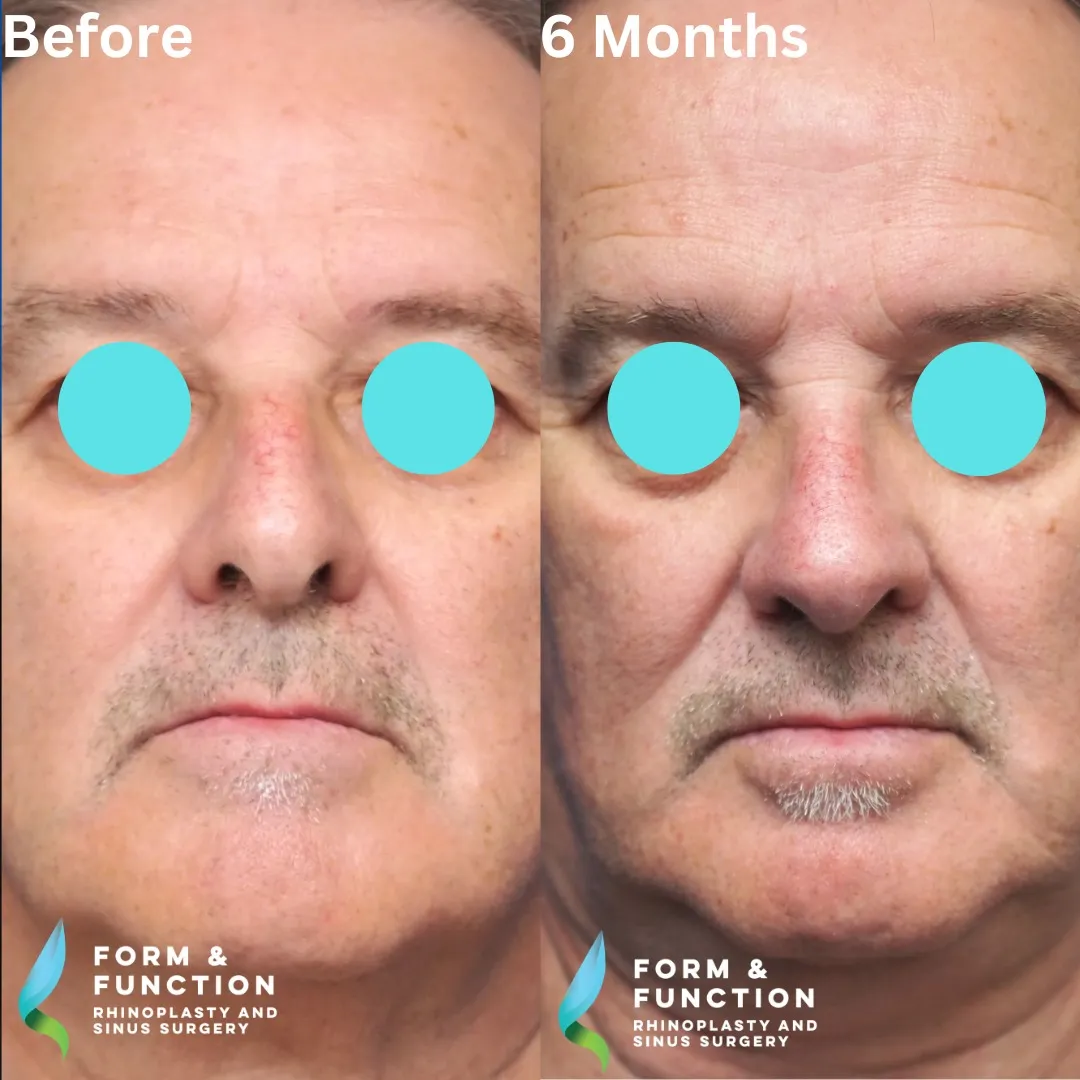 Before and after, 6 months after septorhinoplasty (photograph 5 of 5)