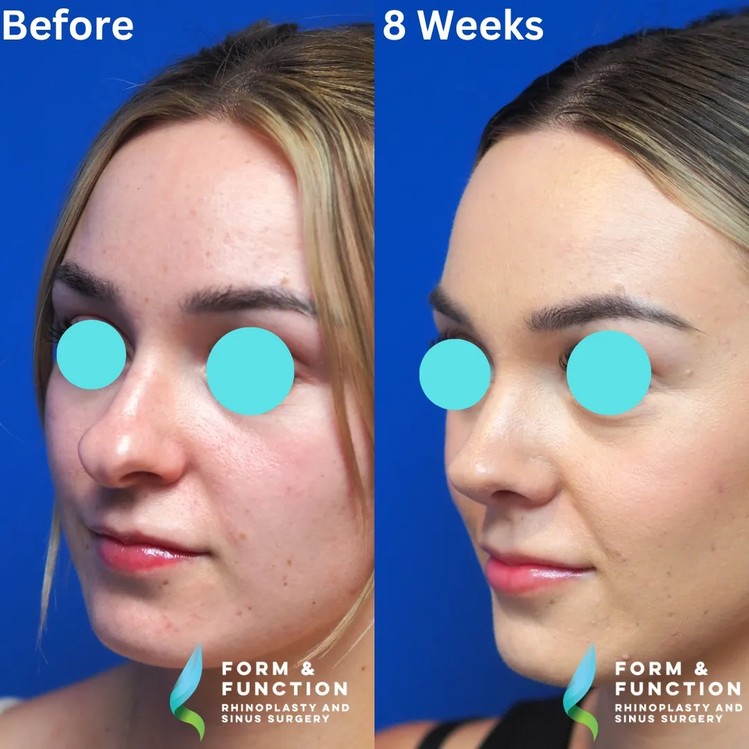 Before and after, left three-quarter view, 8 weeks after rhinoplasty and septoplasty