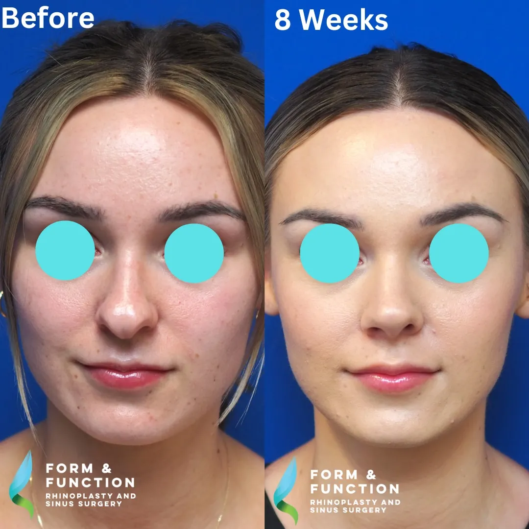 Before and after, frontal view, 8 weeks after rhinoplasty and septoplasty
