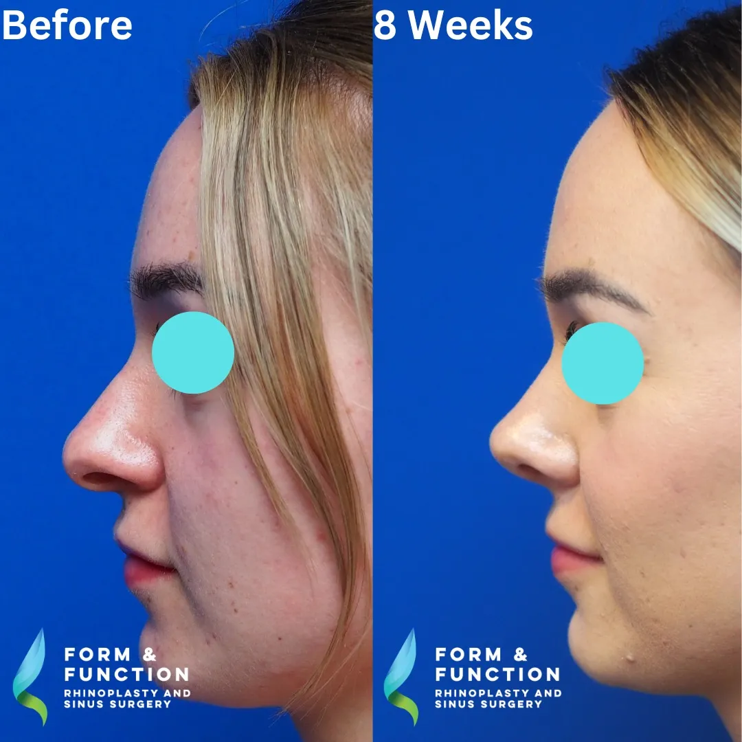 Before and after, right profile, 8 weeks after rhinoplasty and septoplasty
