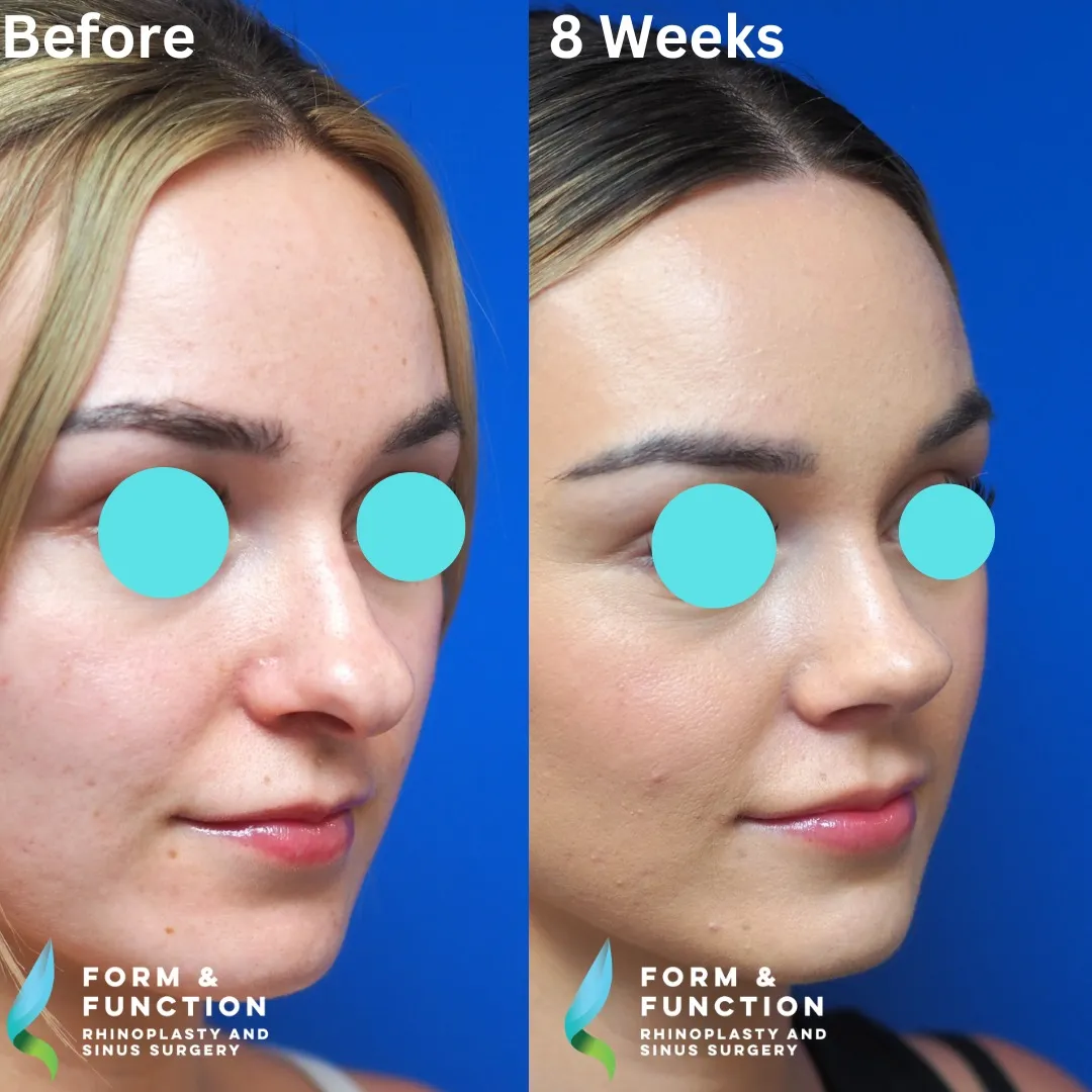 Before and after, 8 weeks after rhinoplasty and septoplasty (photograph 4 of 5)