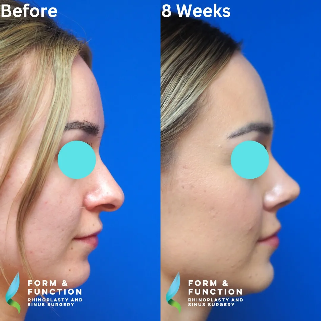 Before and after, 8 weeks after rhinoplasty and septoplasty (photograph 5 of 5)