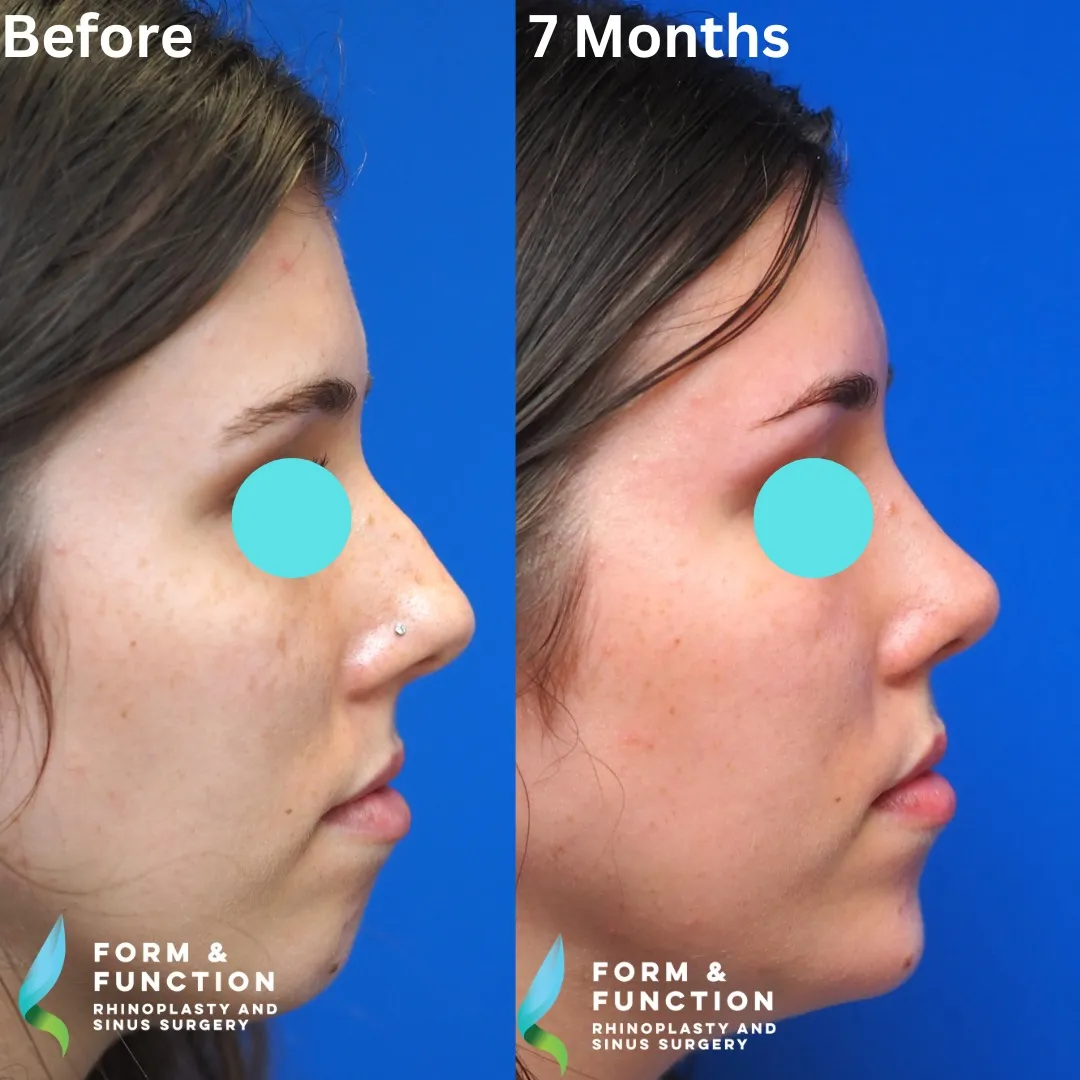 Before and after, right profile, 8 months after rhinoplasty and septoplasty