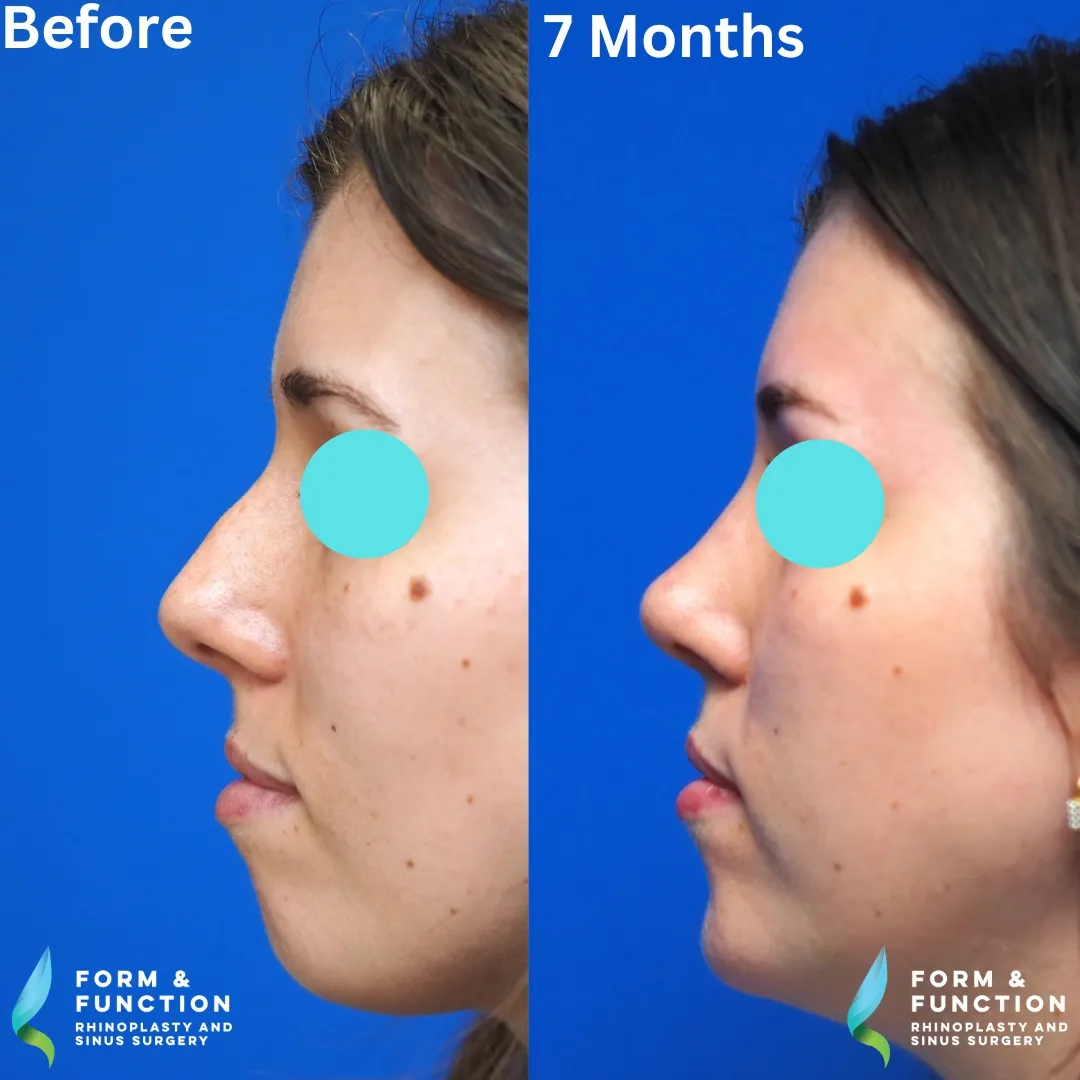 Before and after, 8 months after rhinoplasty and septoplasty (photograph 2 of 5)
