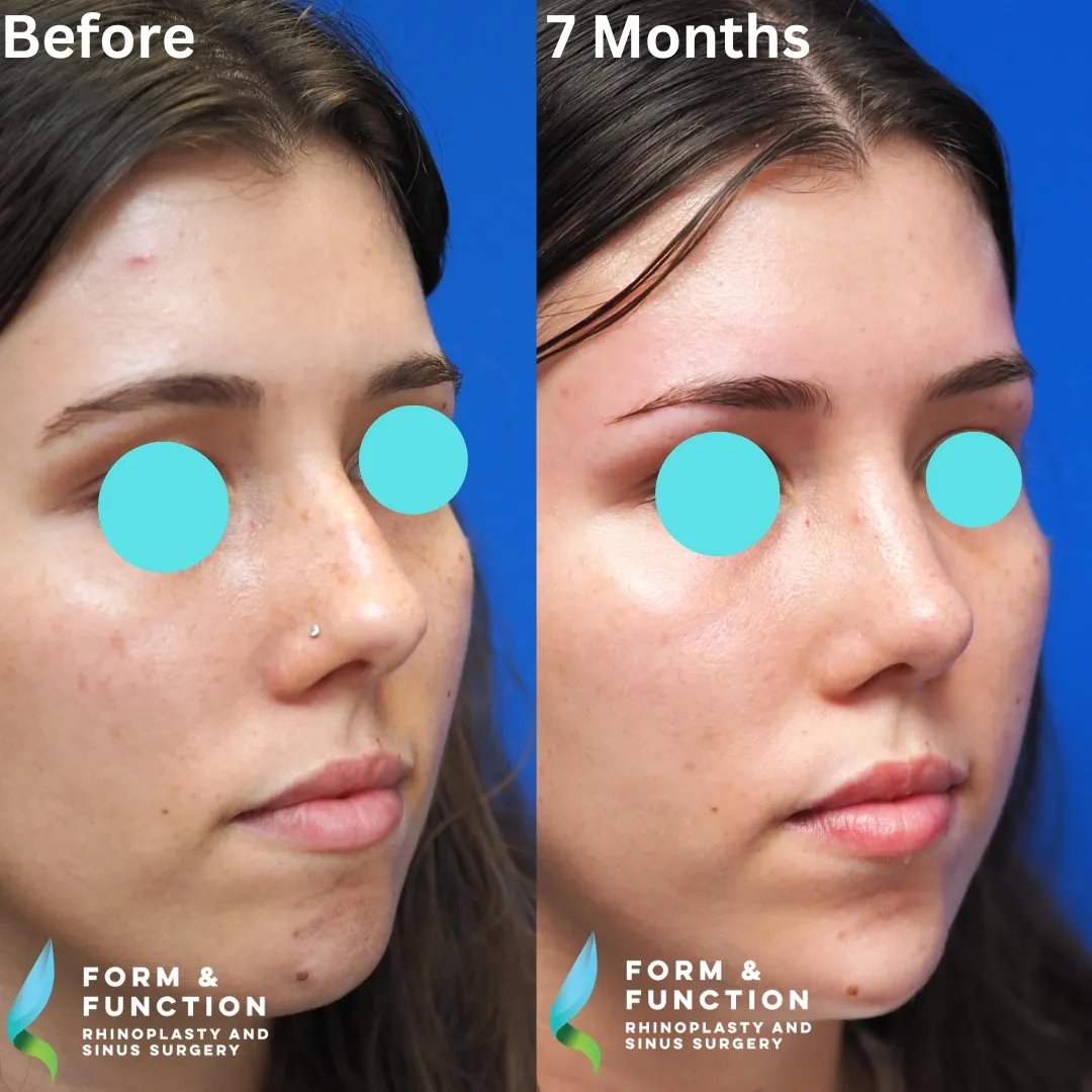 Before and after, right three-quarter view, 8 months after rhinoplasty and septoplasty