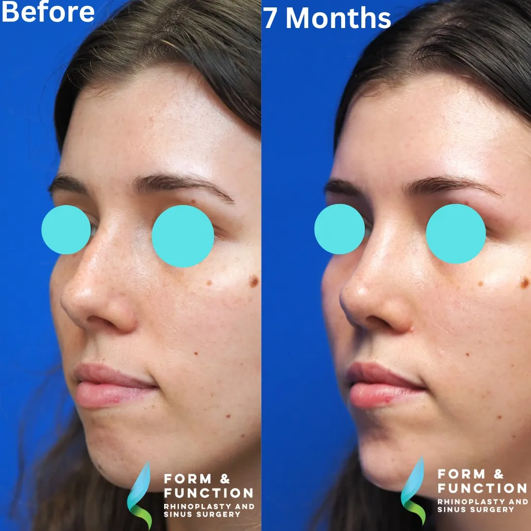 Before and after, left three-quarter view, 8 months after rhinoplasty and septoplasty
