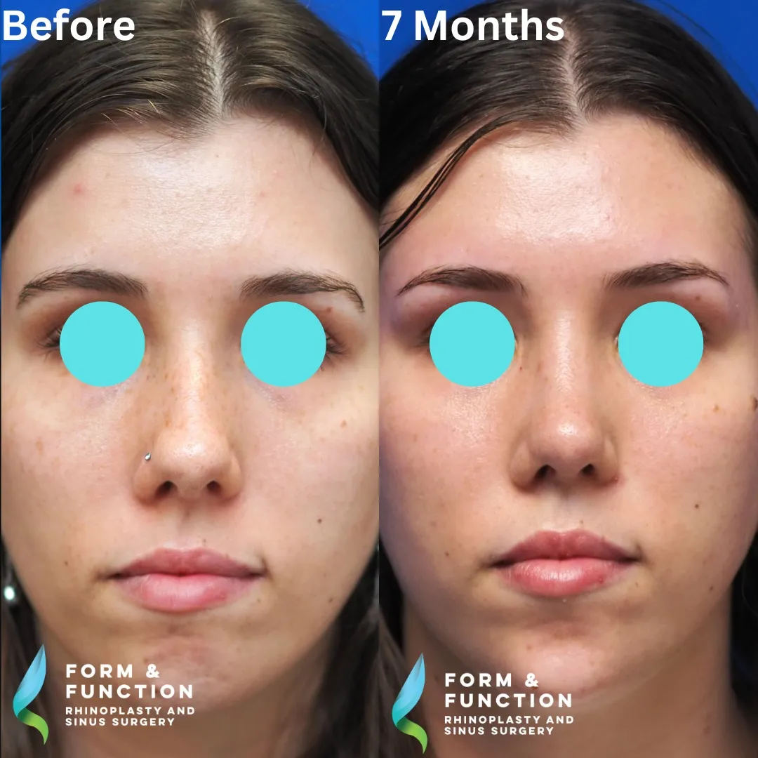 Before and after, frontal view, 8 months after rhinoplasty and septoplasty