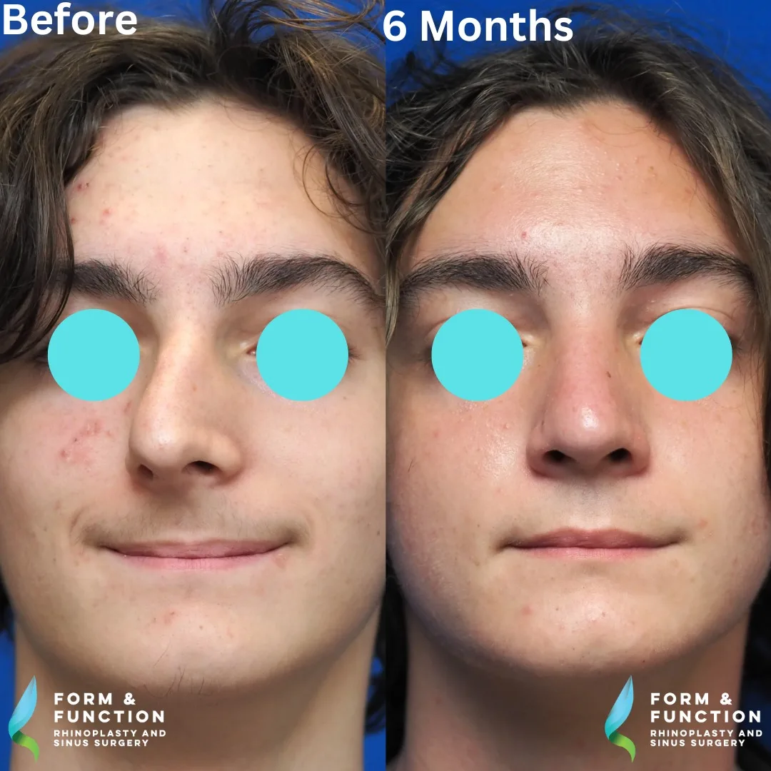 Before and after, frontal view, 6 months after rhinoplasty and septoplasty