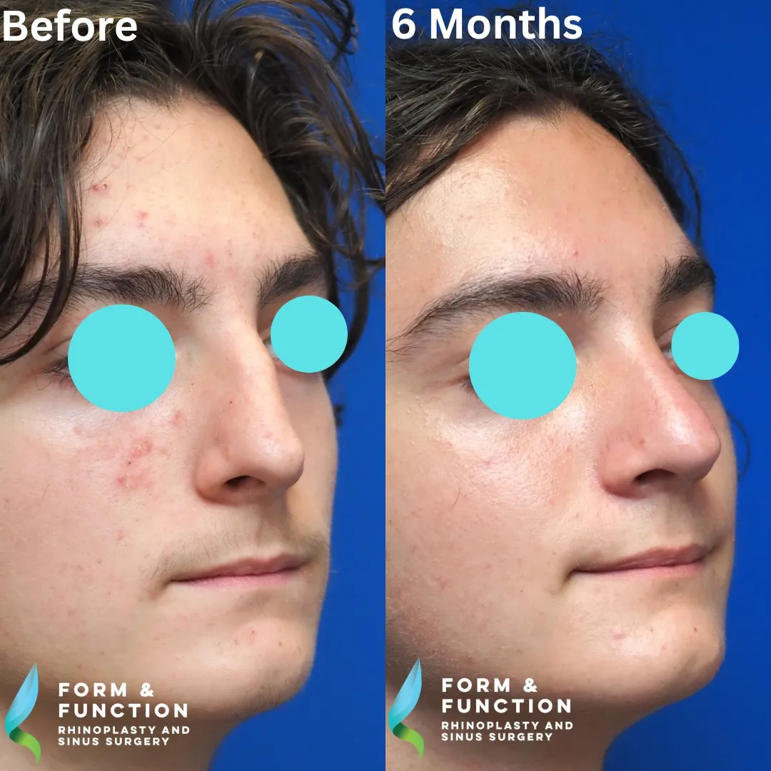 Before and after, right three-quarter view, 6 months after rhinoplasty and septoplasty