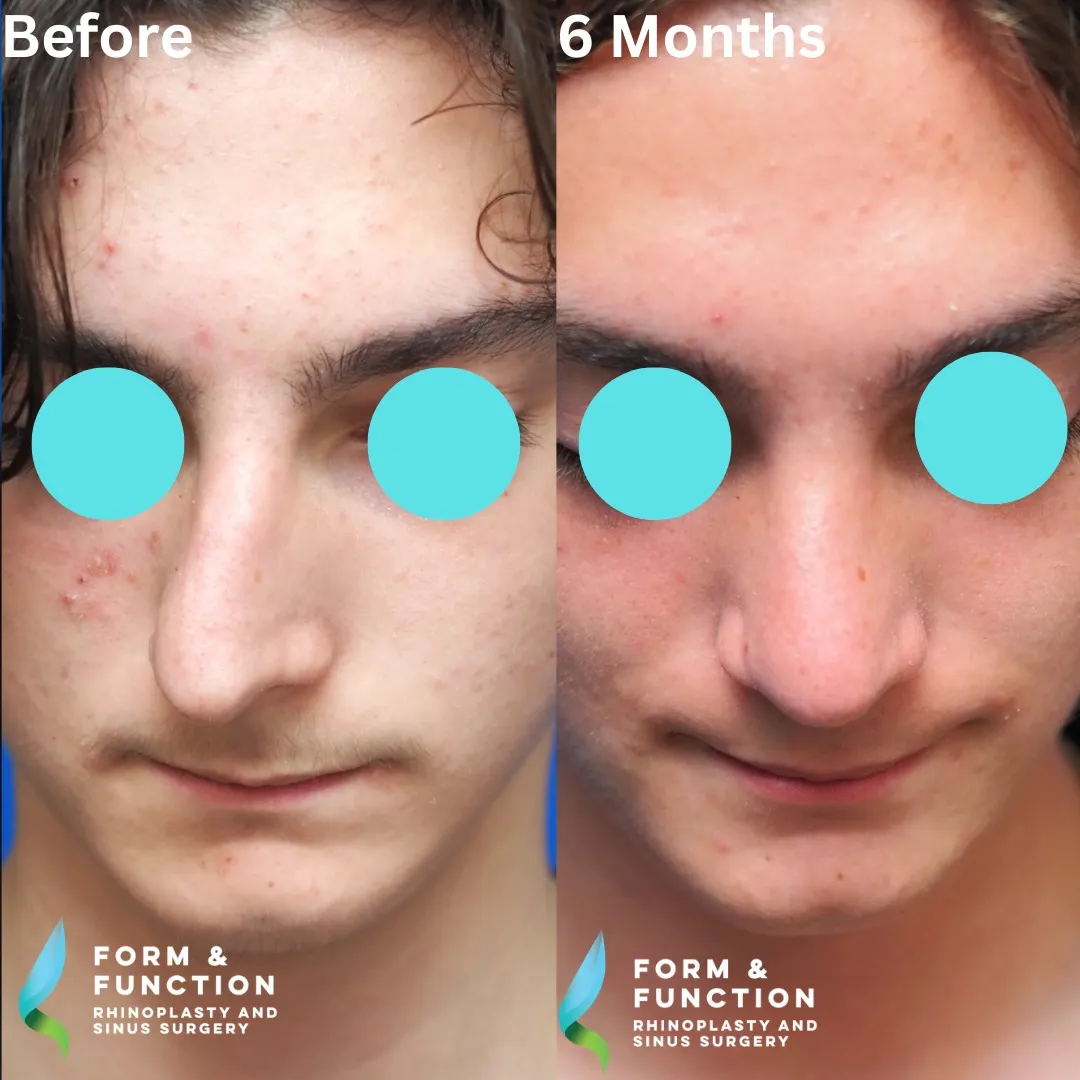Before and after, 6 months after rhinoplasty and septoplasty (photograph 3 of 6)