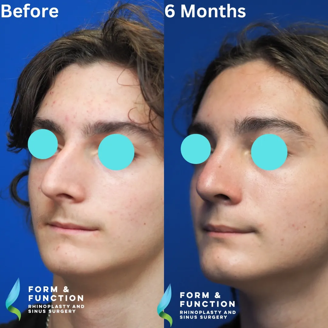Before and after, left three-quarter view, 6 months after rhinoplasty and septoplasty