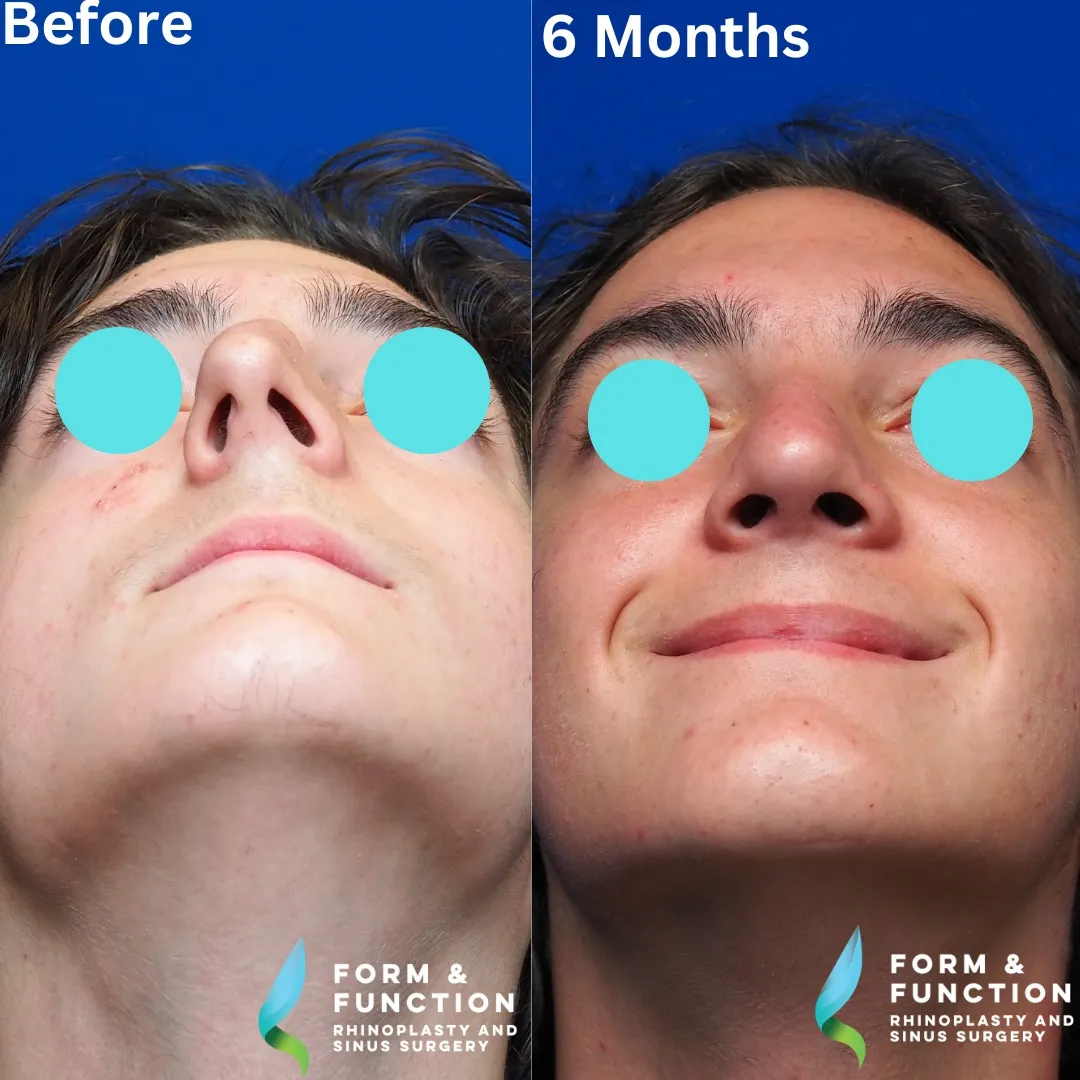 Before and after, base view, 6 months after rhinoplasty and septoplasty