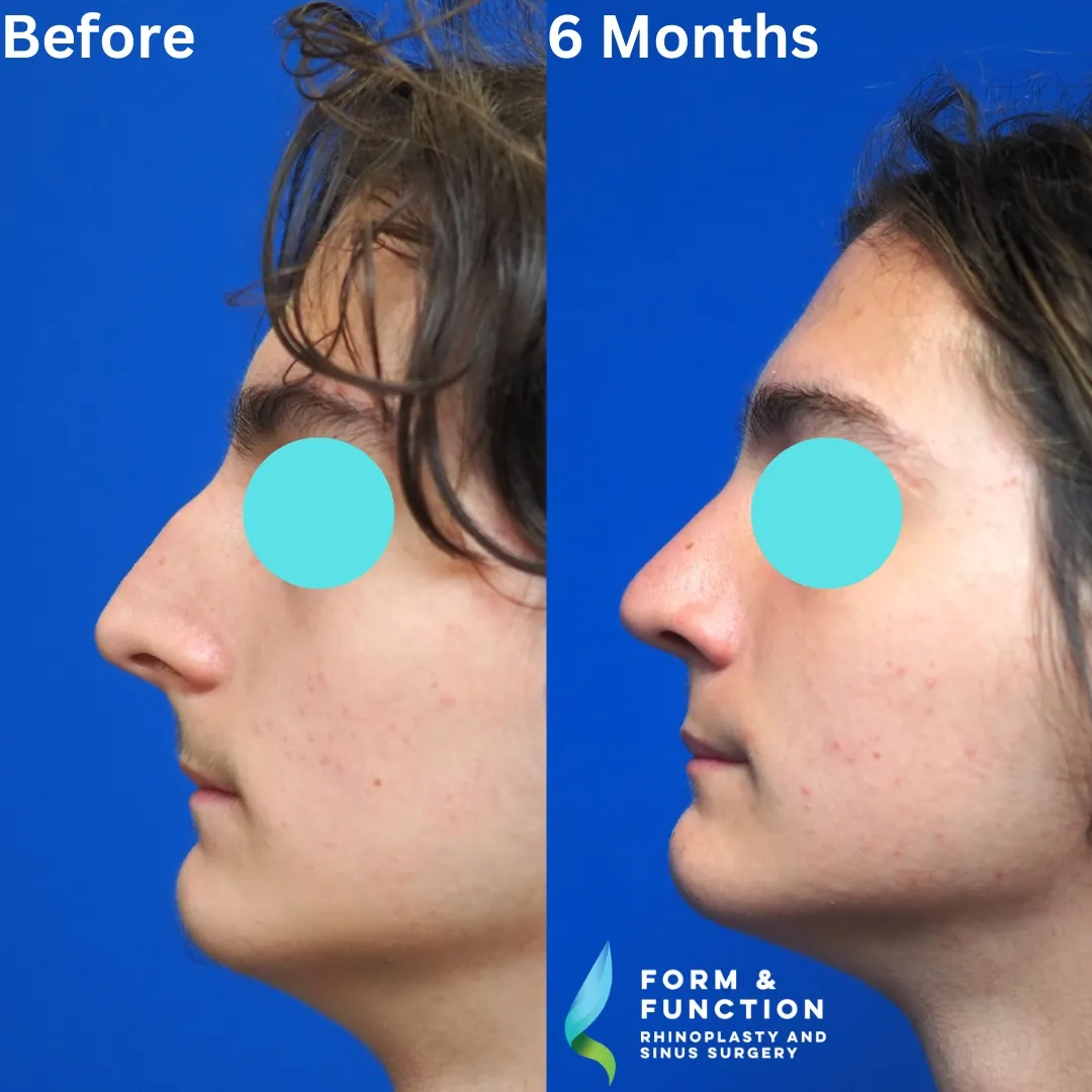 Before and after, right profile, 6 months after rhinoplasty and septoplasty