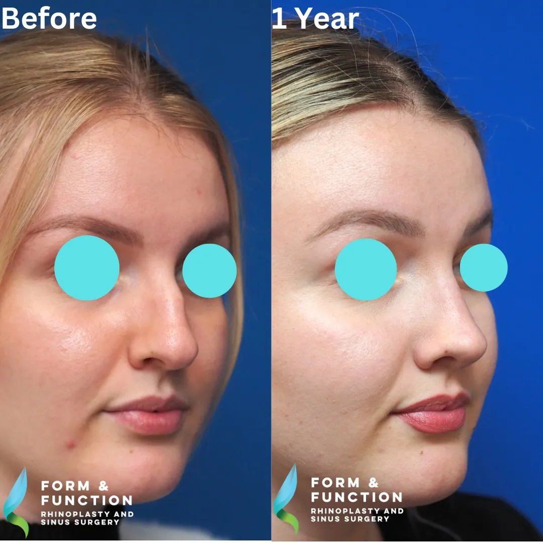 Before and after, left three-quarter view, 1 year after rhinoplasty and septoplasty