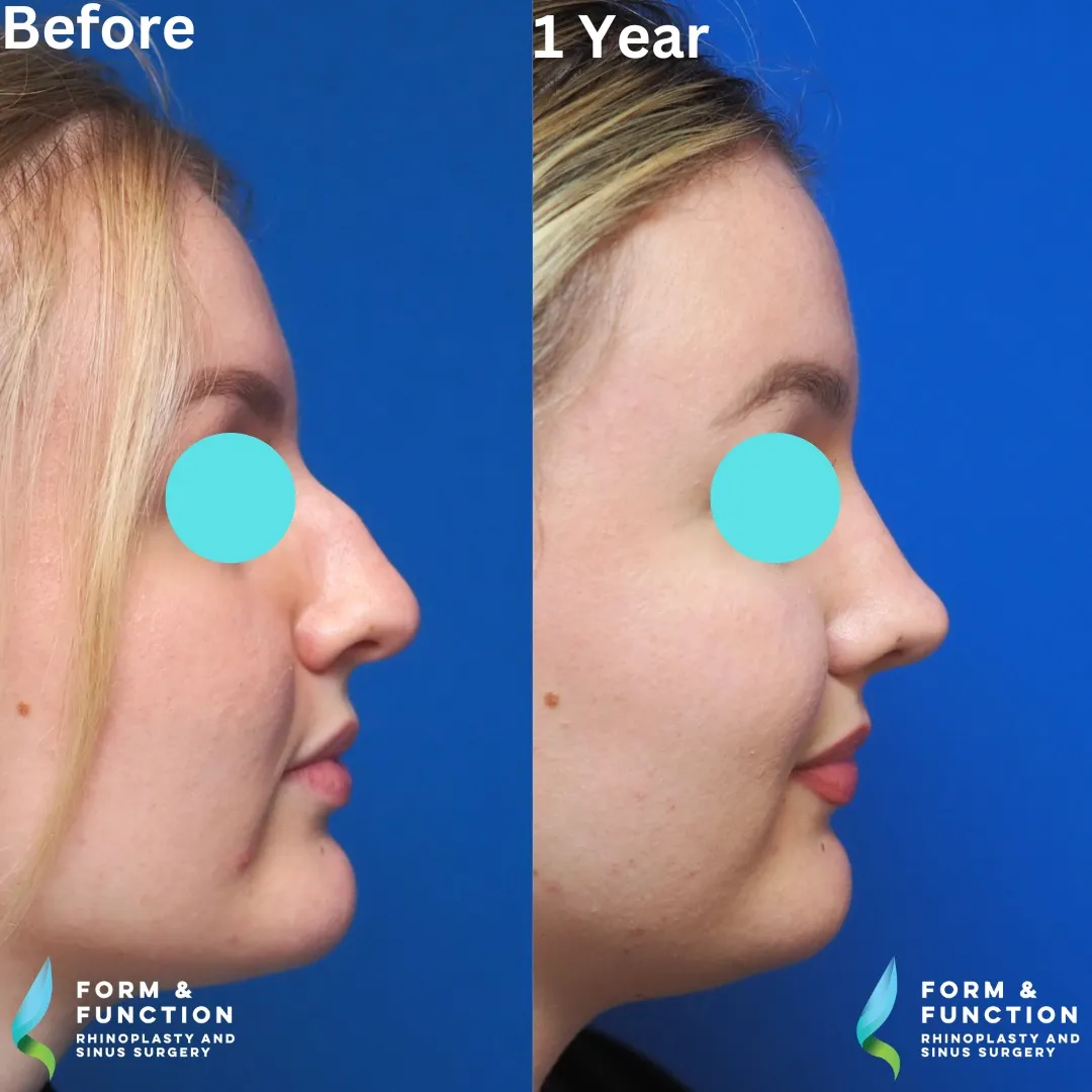 Before and after, right profile, 1 year after rhinoplasty and septoplasty