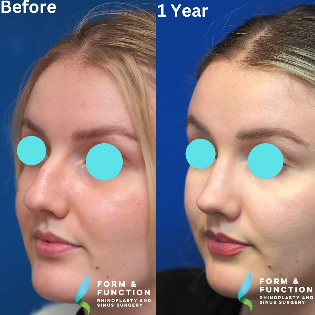 Before and after, 1 year after rhinoplasty and septoplasty (photograph 3 of 6)