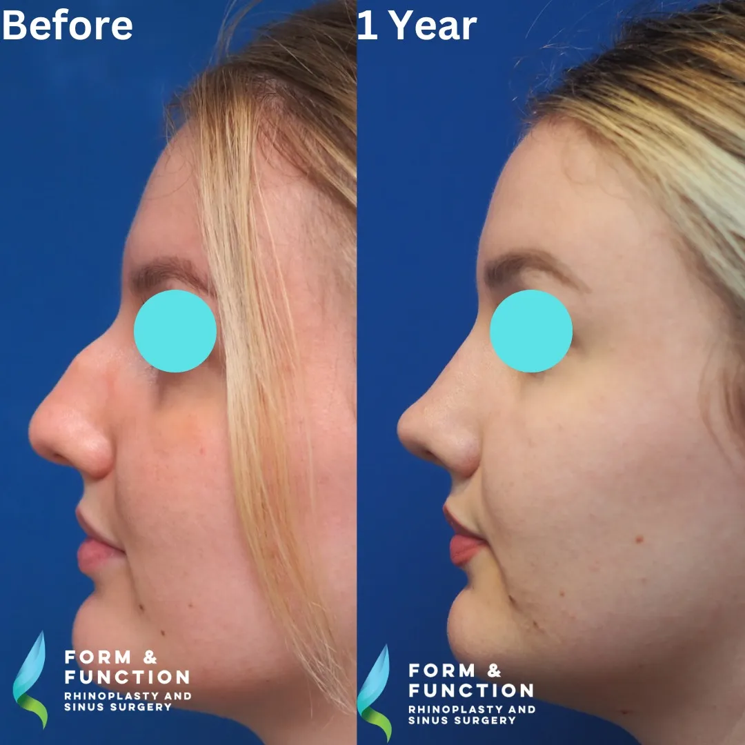 Before and after, 1 year after rhinoplasty and septoplasty (photograph 4 of 6)
