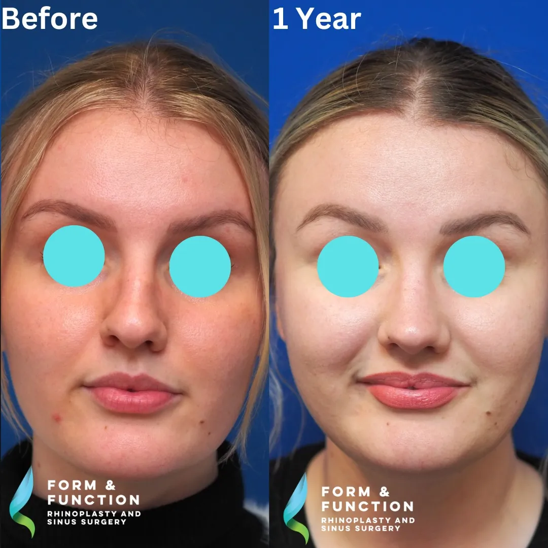 Before and after, frontal view, 1 year after rhinoplasty and septoplasty