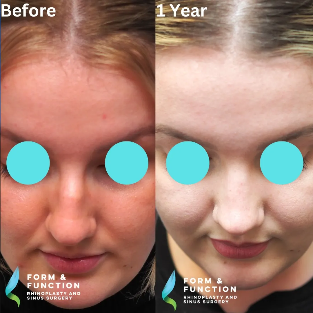 Before and after, base view, 1 year after rhinoplasty and septoplasty