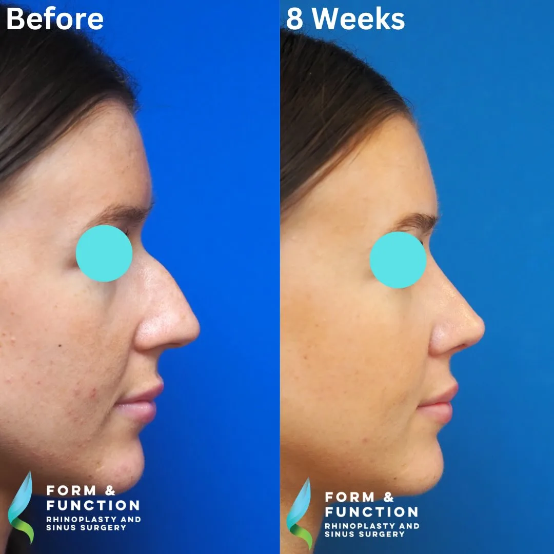 Before and after, right profile, 8 weeks after rhinoplasty and septoplasty