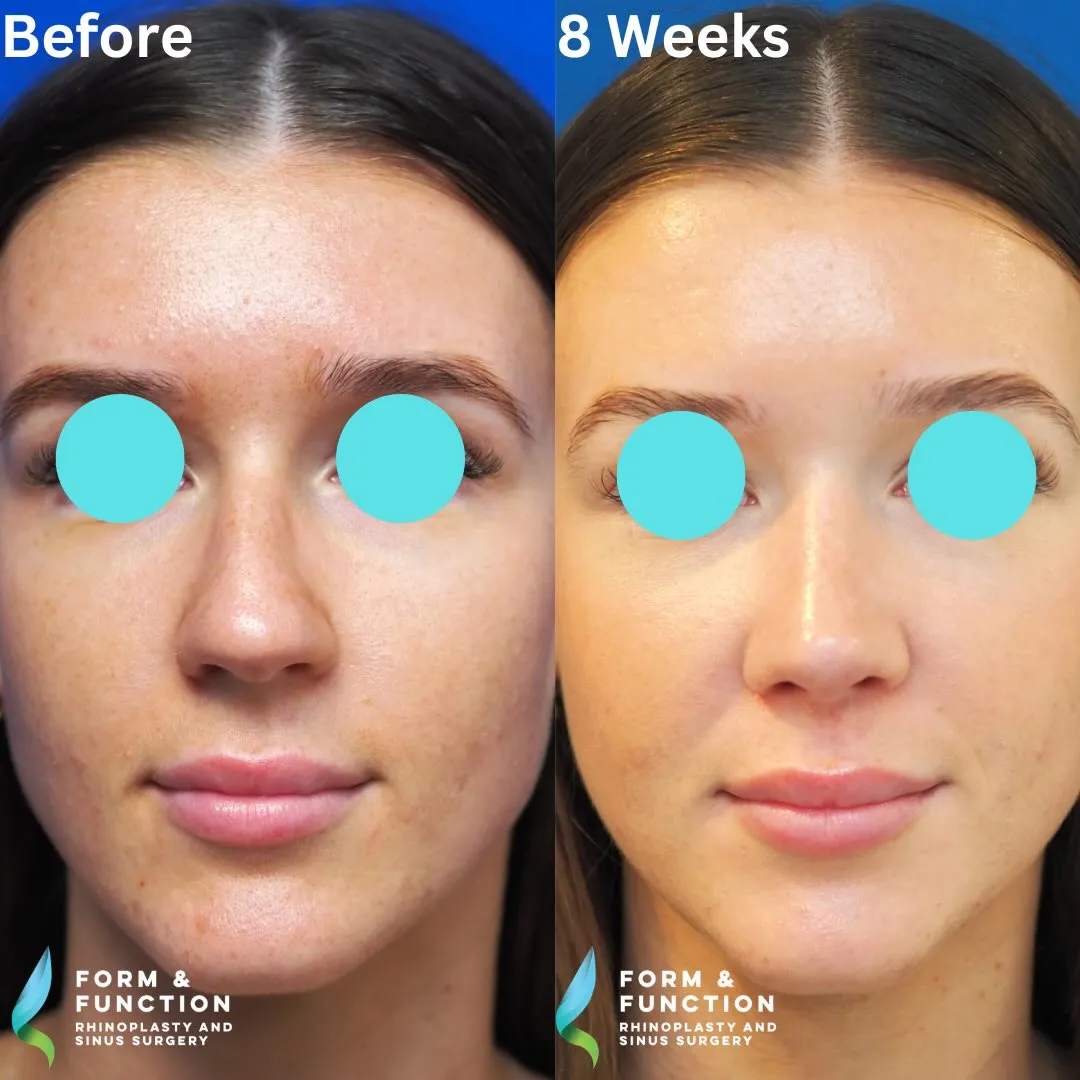 Before and after, frontal view, 8 weeks after rhinoplasty and septoplasty