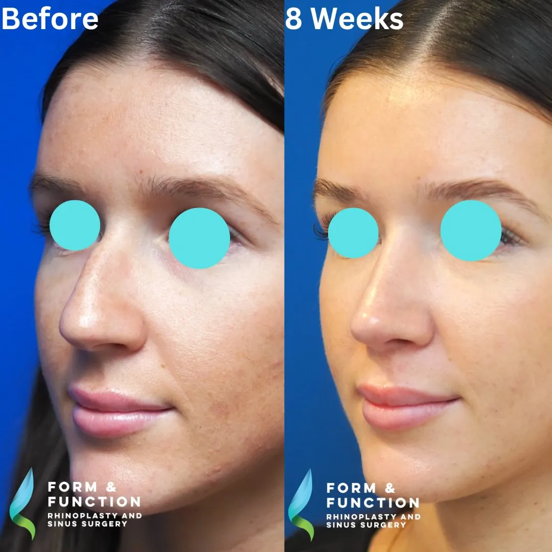 Before and after, left three-quarter view, 8 weeks after rhinoplasty and septoplasty