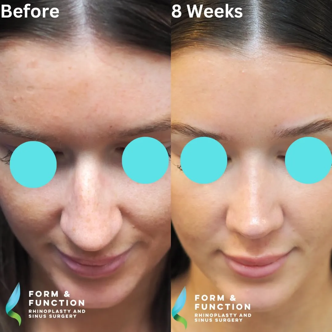Before and after, base view, 8 weeks after rhinoplasty and septoplasty